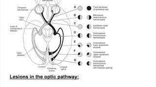 Optic nerve lesions Bitemporal hemianopia heteronymous hemianopiaHomonymous hemianopia [upl. by Tolliver570]