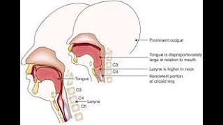 Respiratory obstruction part  2  pathophysiology تمريض [upl. by Atwood883]