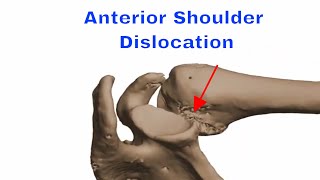 Anterior Shoulder Dislocation 어깨 전방탈구 [upl. by Whatley]