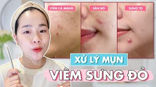 Hướng Dẫn Xử Lý Mụn Viêm Sưng Đỏ ♡ Quin [upl. by Okwu]