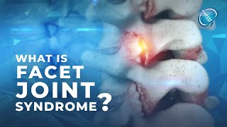 What is Facet Joint Syndrome [upl. by Roselba]