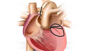 Hypoplastic Left Heart [upl. by Aileduab398]