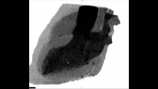 LCX SACCULAR ANEURYSM [upl. by Sudoeht]