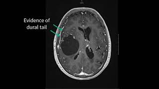 Grade 1 Meningioma [upl. by Kolosick]