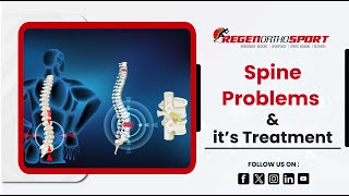 Spine Problems  Symptoms and Treatment Options  RegenOrthoSport [upl. by Nyrem]