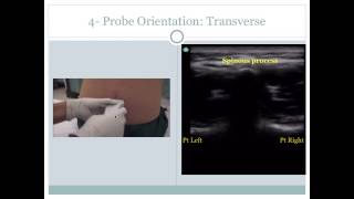 Ultrasound Guided Lumbar Puncture [upl. by Aleinad]