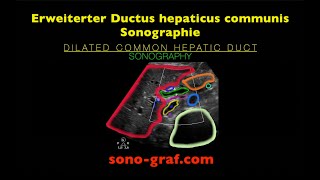 Sonographie  Erweiterter Ductus hepaticus communis [upl. by Aivuy14]