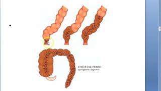 Pediatrics HirschSprung Disease Congenital Aganglionic MegaColon child Not pass Meconium Duhamel [upl. by Ajim]