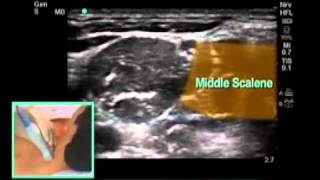 UltrasoundGuided Interscalene Brachial Plexus Nerve Block  SonoSitemp4 [upl. by Ahsiatal584]