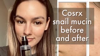 Cosrx snail 96 mucin 1 month review Before and after [upl. by Reider]