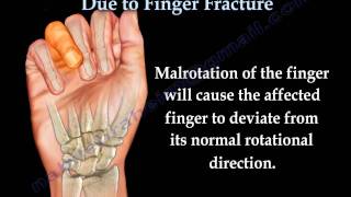 Finger Fractures Malrotation Of The Fingers  Everything You Need To Know  Dr Nabil Ebraheim [upl. by Daggett252]