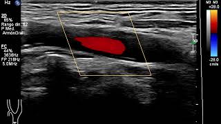 Eco Doppler Carotídeo Affiniti 70 de Philips [upl. by Etnovahs]