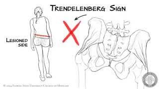 The Trendelenberg Sign HD [upl. by Novanod]