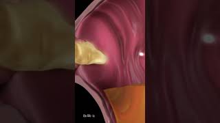 What Is Acid Reflux Animation [upl. by Bondie]