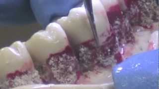 Popular Scaling Tips for Dental Hygienists and Dentists P2L P2R [upl. by Michi532]