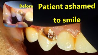 TEETH FILLING  Front Canine decay removal and bonding composite [upl. by Norahs671]