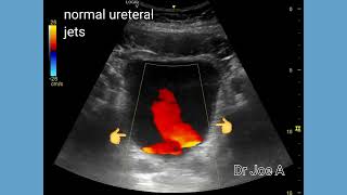 Ureteral or ureteric jets in bladder Ultrasound and color Doppler video [upl. by Medlin]