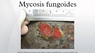 Mycosis fungoides [upl. by Ardnuaek]