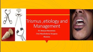 Trismus Management [upl. by Rehoptsirhc667]