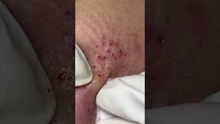 Big Cystic Acne Blackheads Extraction Blackheads amp Milia Whiteheads Removal Pimple Popping shorts [upl. by Kenwood216]