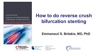 How to perform the reverse crush technique for bifurcation stenting [upl. by Mini]