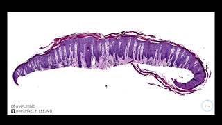 Psoriasis versus nummular dermatitis Dermpath made easy [upl. by Kilah]