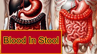 Blood In Stool Melena Vs Hematochezia [upl. by Cutty]