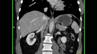 Abdomen Liver Hemangioma of the Liver6 of 8 [upl. by Asinet879]