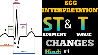 ECG interpretation in hindi  how to read ecg in hindi  ST and T Wave Changes interpretation  4 [upl. by Akcira129]