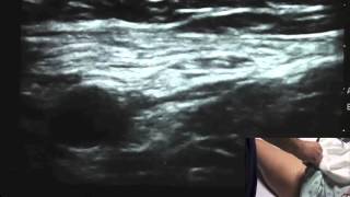 Ultrasound Guided Femoral Nerve Block  SSRAUSAcom [upl. by Anirok]