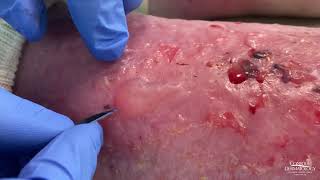 Dermatologist Popping Blisters  CONTOUR DERMATOLOGY [upl. by Casmey]