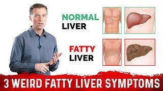 3 Weird Signs amp Symptoms Of Fatty Liver – DrBerg [upl. by Chon444]