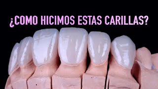 Cómo se hacen las carillas dentales  Proceso realización carillas dentalesDr Roberto Wuotto [upl. by Imoan]