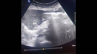 Duodenum obstruction dt AGC진행성 위암 [upl. by Wentworth]