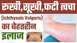 Ichthyosis vulgaris Disease क्या है   रूखीसूखीफटी त्वचा का बेहतरीन इलाज  Dr Health [upl. by Tdnerb242]