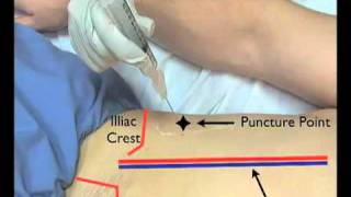 Paracentesis Ultrasound Guided EndoGastroHepnet [upl. by Cleave457]