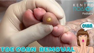 Toe Corn Removal feet toe κεντροποδιου foot podologos calluses podiatrist corn footcare [upl. by Adnalahs733]