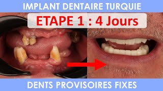 Implant dentaire en Turquie  Implantation bouche complète [upl. by Dewhirst509]