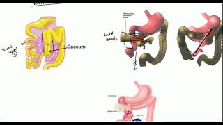 Gut Malrotation Nonrotation and Volvulus for USMLE [upl. by Amek927]