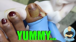 OOEY GOOEY TOENAIL REMOVAL WARNING GRAPHIC [upl. by Hatcher]