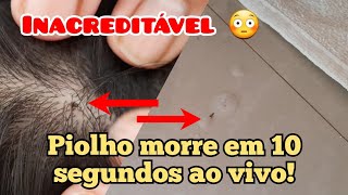 EXTERMINA O PIOLHO EM 10 SEGUNDOS 😳  get rid of lice in 10 seconds [upl. by Ingram]