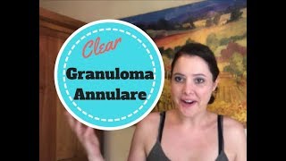 How my Granuloma Annulare Cleared Up [upl. by Naashom]