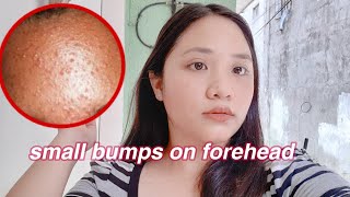 ❤ How To Get Rid Of Tiny Bumps On ForeheadFace Fast  3 days only  Ayisha Arcas ❤ [upl. by Kata122]