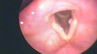 Vocal Fold Granuloma in Reflux Patient [upl. by Annav]