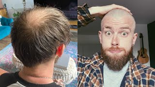 BUZZ CUT vs HIDING MY BALDINGTHINNING CROWN TRANSFORMATION [upl. by Raimondo]