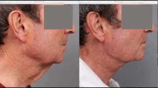 Neck Lift For Men  Dr Sterry [upl. by Enoch188]