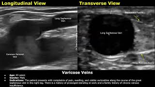 Varicose Veins Doppler Ultrasound Report Example  Lower Limb Venous Insufficiency Sonography USG [upl. by Clinton501]