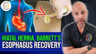 Hiatal Hernia and Barretts Esophagus Recovery with The Reflux Shield [upl. by Sirois]