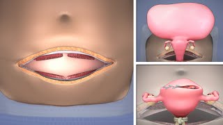 Abdominal Myomectomy through Maylard incision  TVASurg [upl. by Mimajneb887]