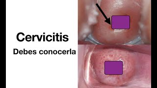 Cervicitis  Causas síntomas diagnóstico y tratamiento  ETS [upl. by Gavrila]